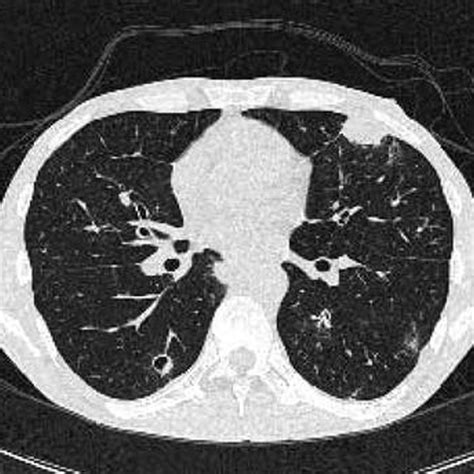 Promising Role of Ultrashort Time Echo MRI in Evaluating Lung ...