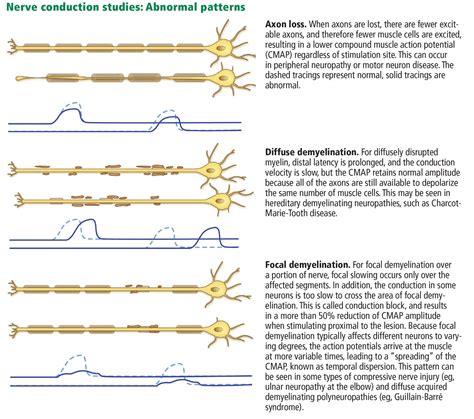 Using and interpreting electrodiagnostic tests | Cleveland Clinic Journal of Medicine