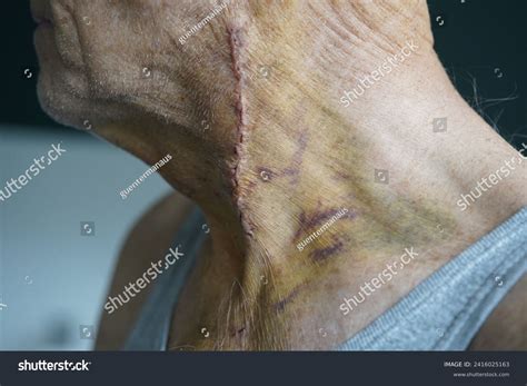 Hematoma Bruise After Carotid Artery Operation Stock Photo 2416025163 | Shutterstock