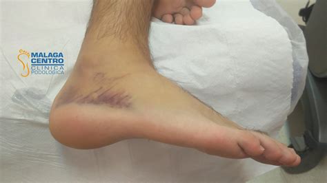 Que Es Un Esguince En El Pie at Matt Wood blog