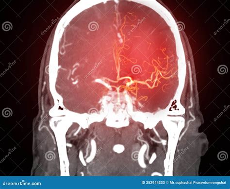 CT Angiography (CTA) Scan of the Brain and Neck, Showcasing the ...