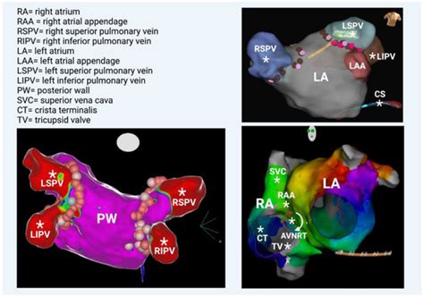 Mechanisms of Atrial Fibrillation: How Our Knowledge Affects Clinical ...