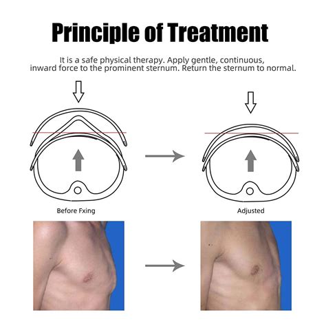 Shuyan Jiao Pectus Carinatum Orthosis Brace - Kids Pigeon Chest Support