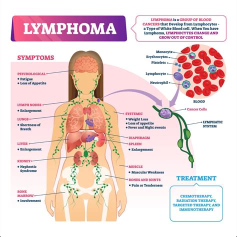 Lymphoma: Causes, Risk Factors, Symptoms, Treatment