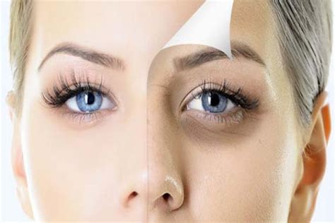 Dark Circle Reduction Treatment in Hadapsar - Skin Angel Aesthetics