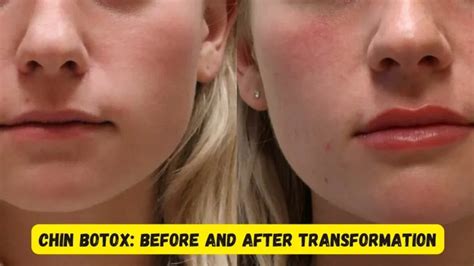 Chin Botox Before and After: Guide to Transforming Your Jawline