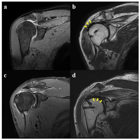 Reinforcement Techniques in Arthroscopic Repair of Large-to-Massive ...