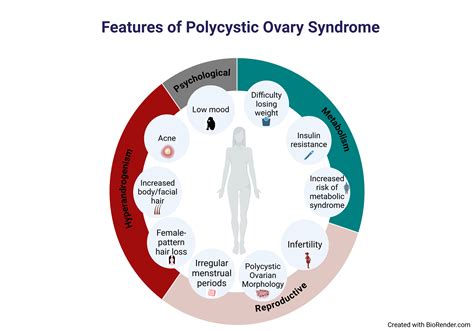 Polycystic ovary syndrome (PCOS) | Endocrine Conditions