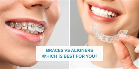 Braces vs. aligners - which is best for you
