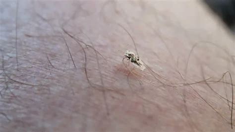 Image result for Insect Removal From Humans