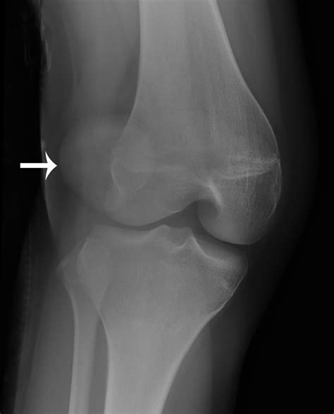 Knee Patellar Dislocation X Ray