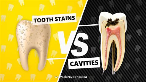 TOOTH STAINS VS. CAVITIES - D'arcy Dental