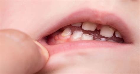 Image result for Exploding Mouth Cyst