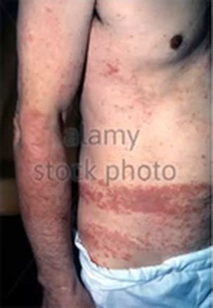 Image result for Hair Splinter Infection