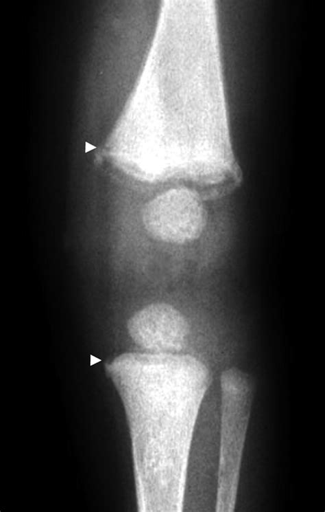 Bucket Handle Fracture