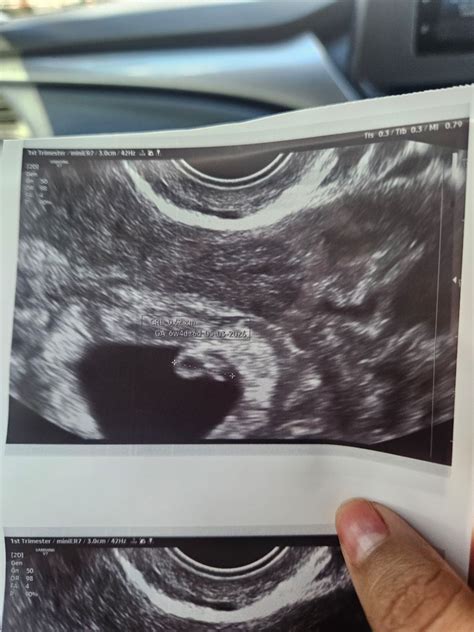 The image shows an early first-trimester ultrasound. Crown-Rump Length (C..