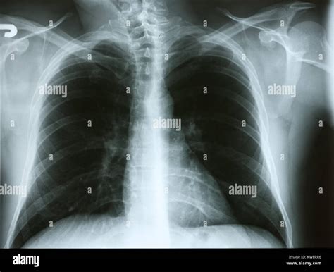 Mucus In Lungs X Ray