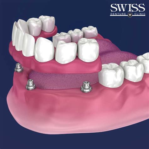 Implant Dentures in Calgary - Life-Changing Benefits