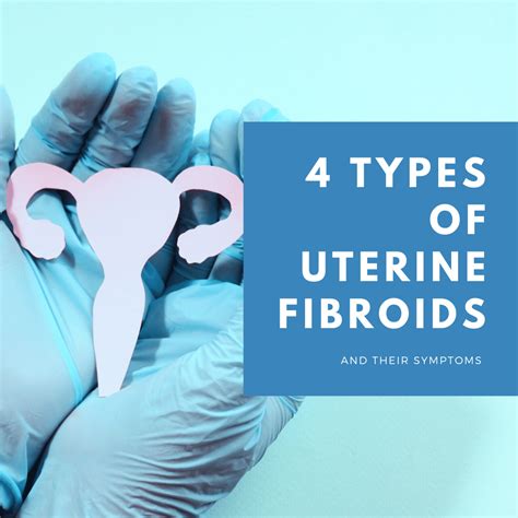 4 Types of Uterine Fibroids and Their Symptoms | New York City | 1 Fibroid Center