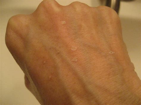 Chemical Peels for Acne and Anti Aging: Hand Age Spots Treated with TCA Peel: Days 1-10