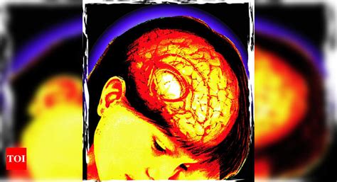 'New radiation therapy doesn't lower IQ' - Times of India