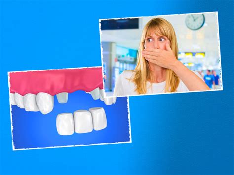 What to do if Dental Cap or Crown Falls Out in Hindi | डेंटल कैप या टूथ ...