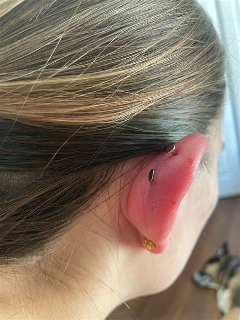 What Does A Helix Infection Look Like at Erin Mackenzie blog