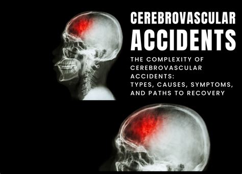 Image result for CVA Recovery