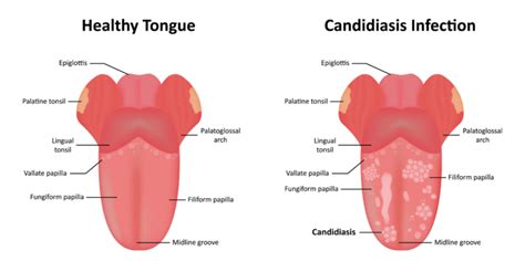Candidiasis bucal: causas, síntomas y tratamiento | Teeth 22