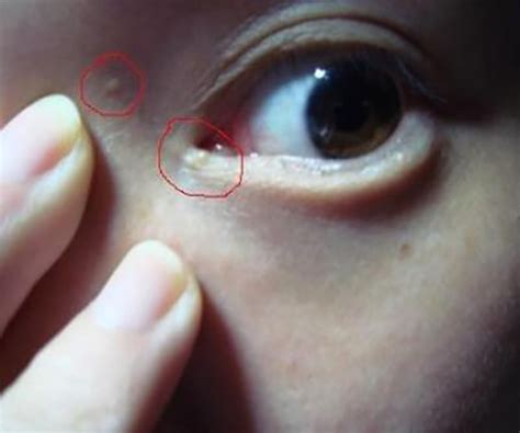 眼周围长的小颗粒到底是什么？10秒学会正区分脂肪粒、汗管瘤、扁平疣！ - 知乎