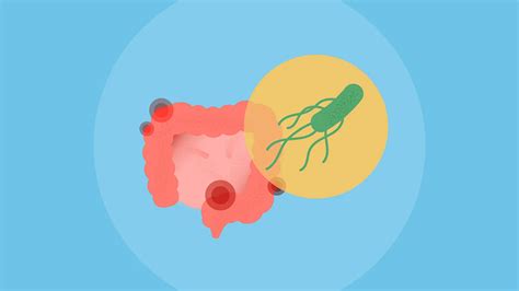 What Are the Causes and Risk Factors of Colon Cancer?