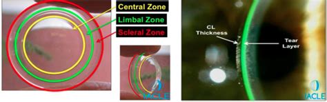 The Science behind Scleral Lenses