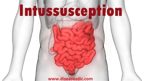 Image result for Intussusception Symptoms