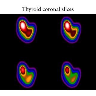 Image result for Ramp Kernel Filter Convolution
