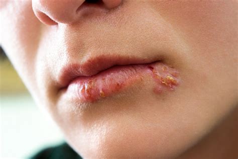Herpes im Mund – Auslöser und Behandlung – Heilpraxis