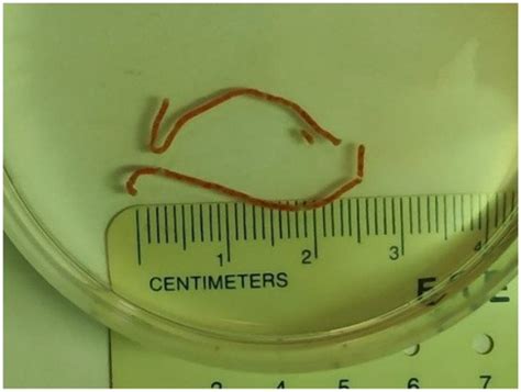 Endoscopic Ultrasound in Liver Disease | Encyclopedia MDPI