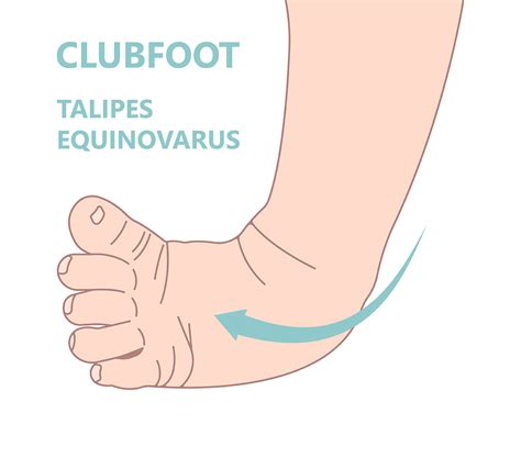 What Is Clubfoot Treatments And Symptoms Facty Health What Are The 5