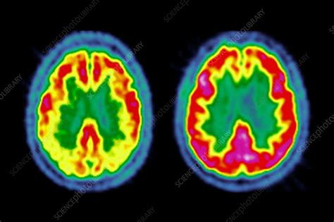 Image result for Dat Scan Lewy Body