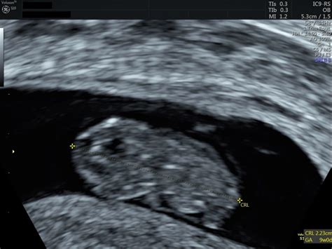 Ultrasound 的图像结果