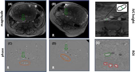 Lateral Recumbent Fetal Position