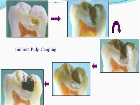 Image result for Difference Between Direct and Indirect Pulp Capping