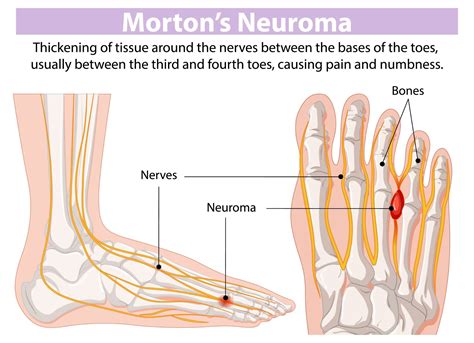 Morton's Neuralgia: Causes, Symptoms, and Evidence-Based Podiatry Treatments | Morton Neuroma