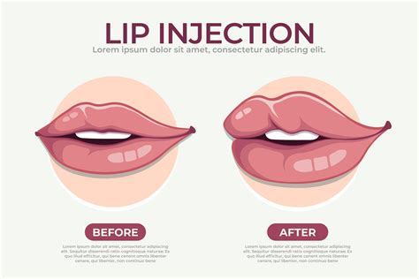 Lip Botox Before and After: Stunning Results, Lip Flip Secrets & Expert Guide - RubMD | Stay ...