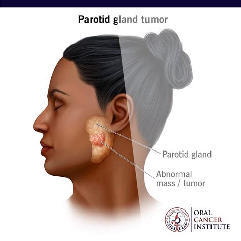 Parotid Gland Cancer