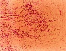 Image result for 败血病 blood poisoning