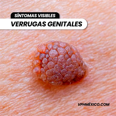VPH en México: Síntomas, Prevención y Tratamiento - VPH EN MÉXICO