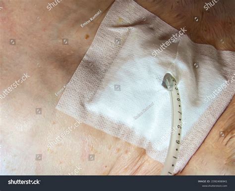 Endoscopic Gastrostomy Placement at Cheryl Lee blog