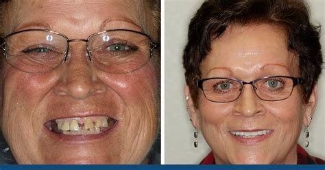Image result for Dentures Look Real