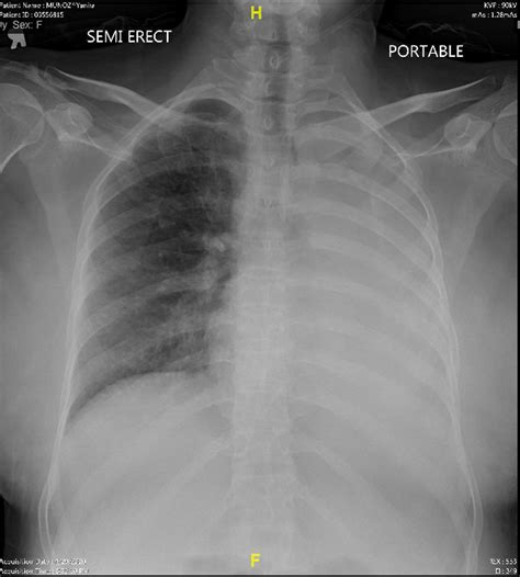 Phlegm In Lungs X Ray