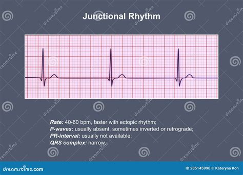 Electrocardiogram Displaying a Junctional Rhythm, 3D Illustration Stock ...